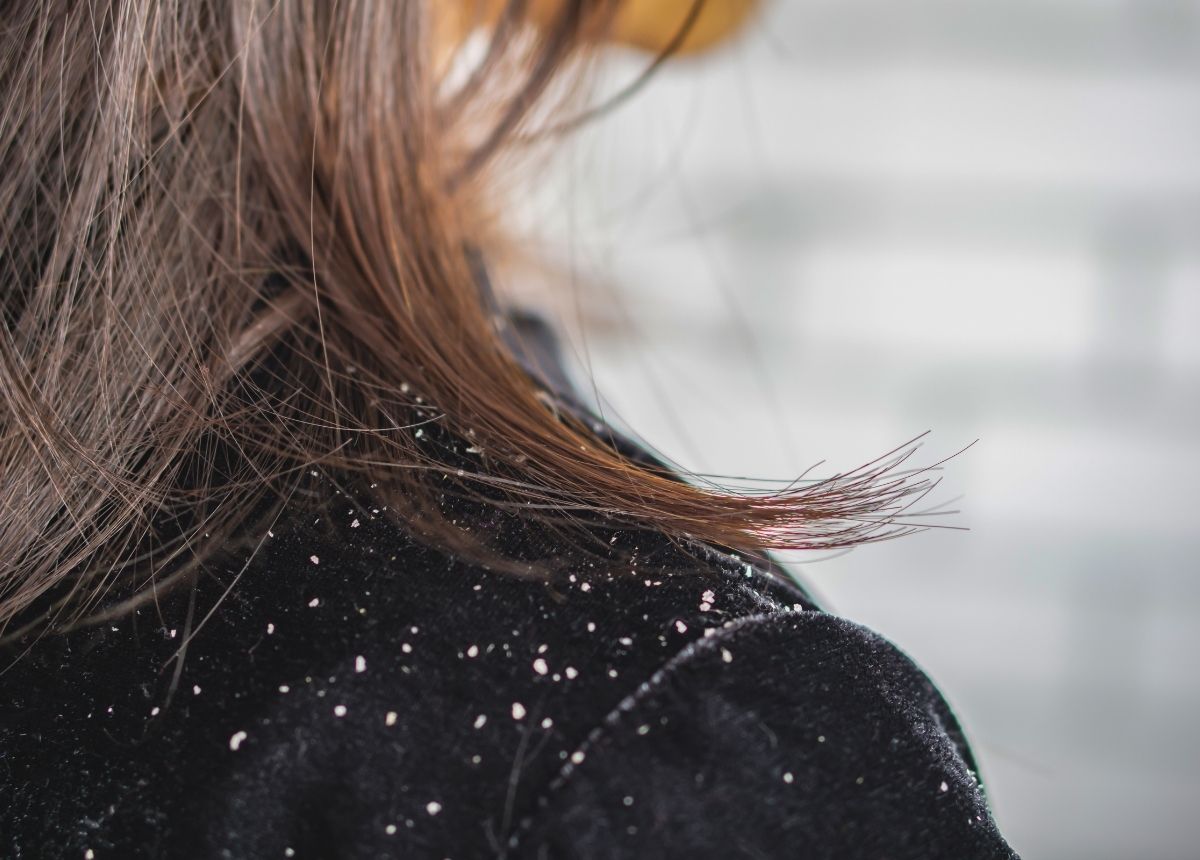 Berita gaya hidup, kesehatan, dan tips terbaru hari ini: 4 cara ini bisa anda lakukan untuk hilangkan ketombe. Anda bisa rajin keramas, menggunakan tea tree oil, kurangi konsumsi gula dan mencoba cuka apel.