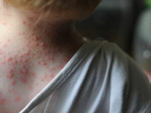 WHO mengidentifikasi cacar monyet telah menyebar ke lebih dari 50 negara di dunia. Namun kondisi ini belum ditetapkan sebagai pandemi.