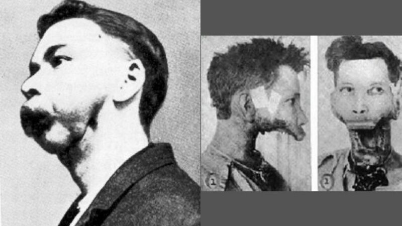 Atlet Ini Kehilangan Rahang Setelah Minum 1400 Lebih Botol Air Radioaktif