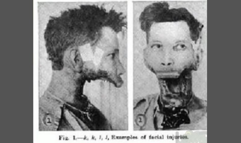 Atlet Ini Kehilangan Rahang Setelah Minum 1400 Lebih Botol Air Radioaktif 4 Lampiran Gambar