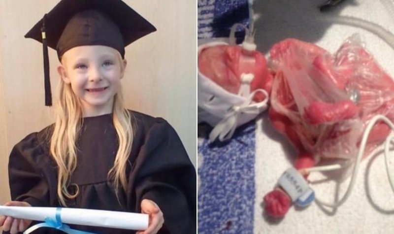 Bayi yang lahir seukuran kantong plastik kecil akan memulai masuk sekolah dasar pada Desember mendatang. [Mirror]