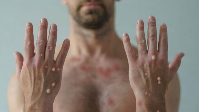 WHO telah nyatakan virus cacar monyet sebagai darurat kesehatan global. Ada beberapa gejala yang wajib di waspadai oleh masyarakat.