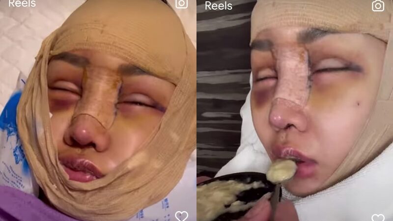 Lucinta Luna curhat betapa susahnya untuk makan usai lakukan operasi di baguah leher dan wajah untuk menjadi wanita yang sempurna, Selasa (12/7/2022).