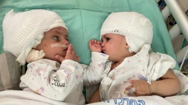 Momen Haru Bayi Kembar Siam Melakukan Kontak Mata Pertama Kalinya Setelah Operasi Pemisahan