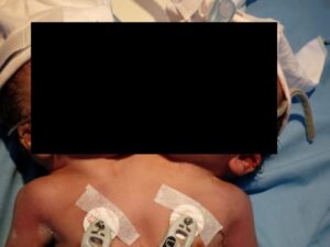 Bayi kembar siam tersebut dilahirkan Ayu Septiani, warga Kecamatan V Koto Timur, Kabupaten Padang Pariaman