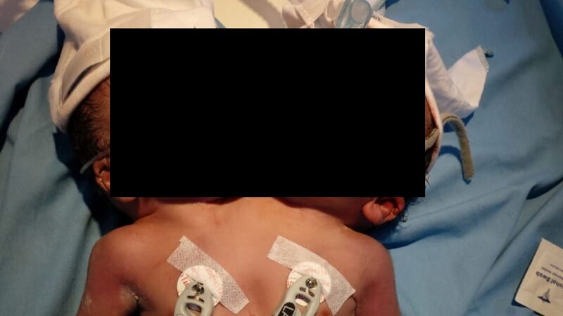 Bayi kembar siam tersebut dilahirkan Ayu Septiani, warga Kecamatan V Koto Timur, Kabupaten Padang Pariaman