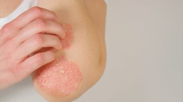 https://www.healthdigest.com/1017935/foods-to-eat-and-to-avoid-for-psoriasis/