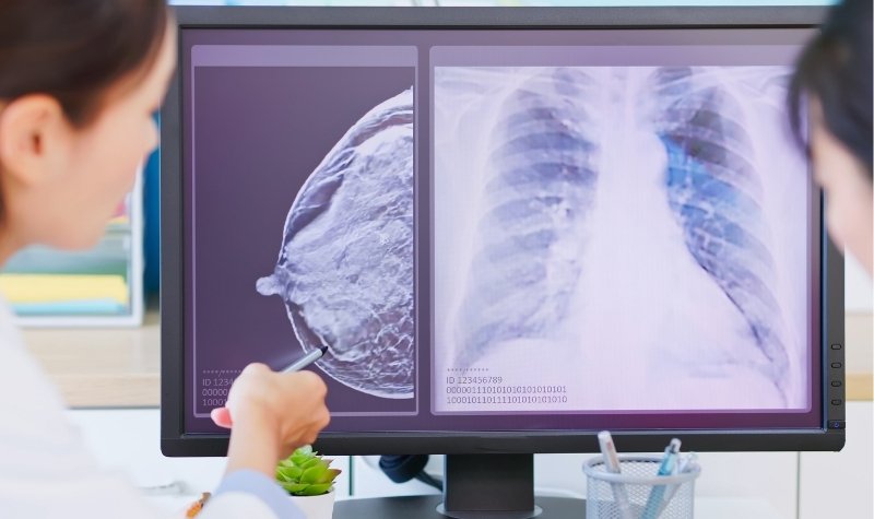 Kanker Payudara Bisa Menyerang Laki-laki? Ini Jawabannya 2 Lampiran Gambar