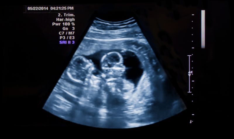 Ini Tanda-tanda Awal Anda Bisa Hamil Anak Kembar 2 Lampiran Gambar