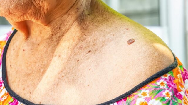 Cekricek.id - Berbagai macam orang khawatir keberadaan skin tag yang berada di area leher dapat menjadi penyakit berbahaya, seperti kanker