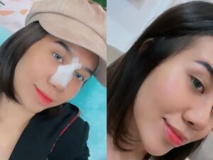 Cekricek.id - Mayang Lucyana yang sempat membuat gempar karena operasi plastik yang dijalaninya kini sudah melepas perban di hidungnya. Dia bahkan terlihat mengunggah konten video dengan penampakan hidung barunya yang mancung.