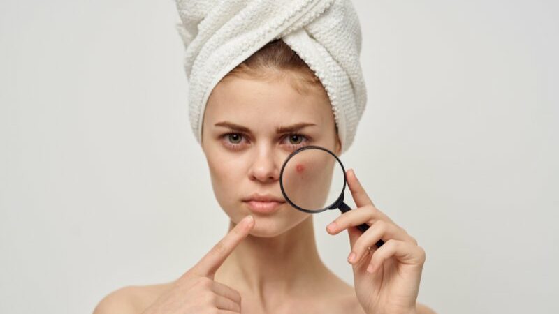 Cekricek.id - Jerawat yang meradang sering kali membuat penderitanya merasa tidak nyaman. Selain karena rasa sakit, bintik merah yang menonjol di area wajah ini juga sangat mengganggu penampilan.