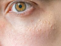 Cekricek.id – Milia adalah bentuk benjolan kecil-kecil di area wajah terutama di sekitar bawah mata yang mirip dengan jerawat. Sering dibilang mirip kulit ayam, namun kondisi tersebut bukanlah karena jerawatan. Melainkan karena adanya penumpukan sel kulit mati yang terperangkap di bawah permukaan kulit.