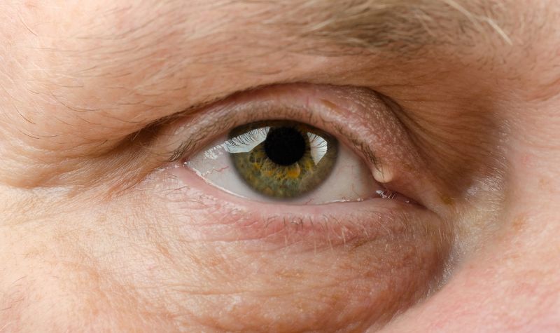 Apa Penyebab Kelopak Mata Terkelupas? 2 Lampiran Gambar