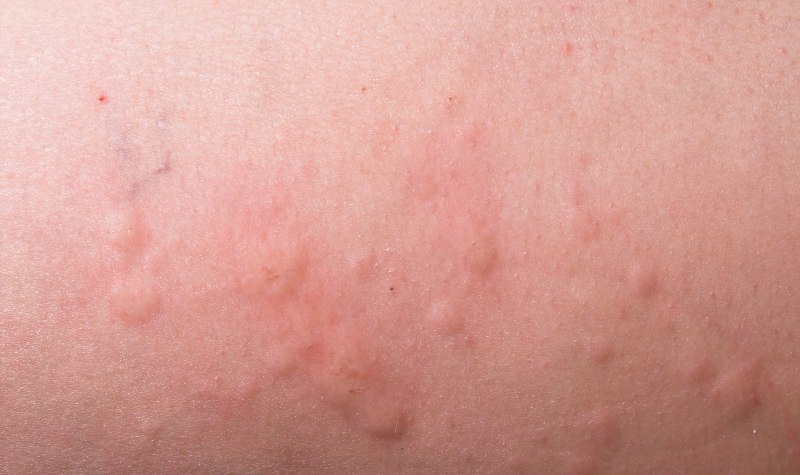 Waspada, Begini Gejala Angioedema pada Tubuh Anda 2 Lampiran Gambar