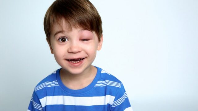 Cekricek.id - Adanya pembengkakan pada bagian jaringan tubuh dikenal dengan istilah angioedema. Kenali begini gejala serta pengobatannya