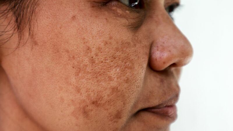 Cekricek.id, Kecantikan - Dengan bantuan treatment penghilang flek masalah yang ada pada wajah ini dapat diatasi dengan mudah