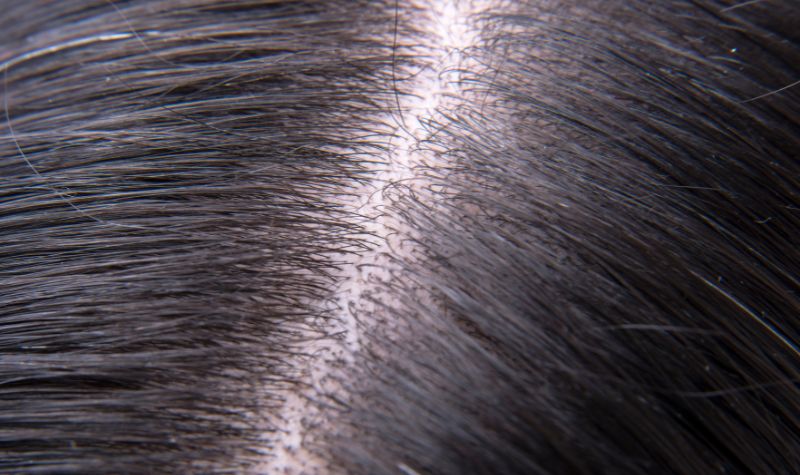 Cara Ampuh Menghilangkan Ketombe Tebal dan Berkerak di Kulit Kepala 2 Cekricek.id, Kesehatan -  Cara Ampuh Menghilangkan Ketombe Tebal dan Berkerak di Kulit Kepala