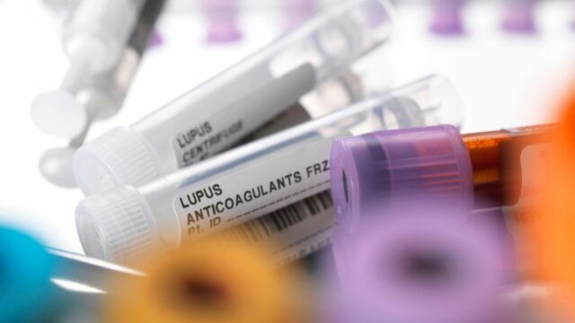 Cekricek.id, Kesehatan - Apakah Ada Hubungan Antara Lupus dan Anxiety?