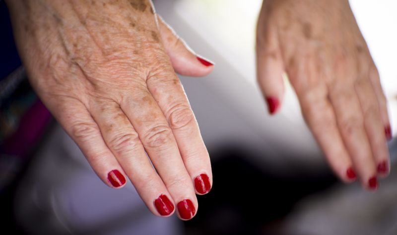 Cekricek.id, Kesehatan - Apakah Ada Hubungan Antara Lupus dan Anxiety?