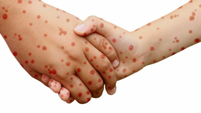 Cekricek.id, Kesehatan - Sejak tahun 2022, Indonesia mengalami peningkatan kasus suspek dan konfirmasi campak yang lebih tinggi dibandingkan tahun-tahun sebelumnya.  Campak sendiri merupakan penyakit endemik di Indonesia yang dilaporkan setiap tahunnya.