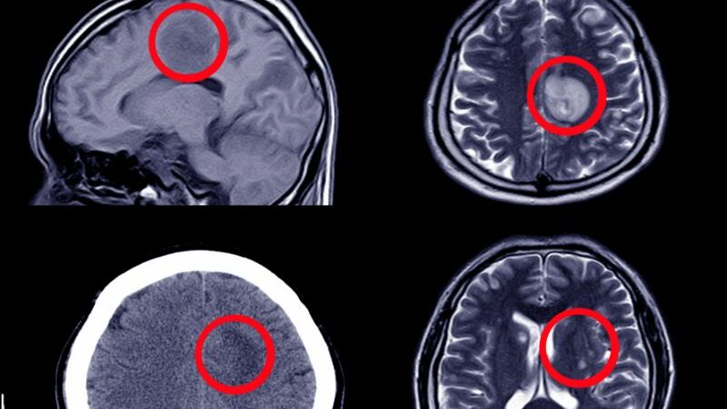 Cekricek.id, Kesehatan - Bagi orang tua tentu perlu mengenali penyebab hidrosefalus. Serta mengetahui lebih rinci bagaimana cara mengatasi